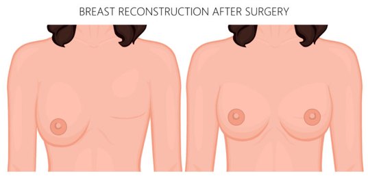 what is breast reconstruction surgery