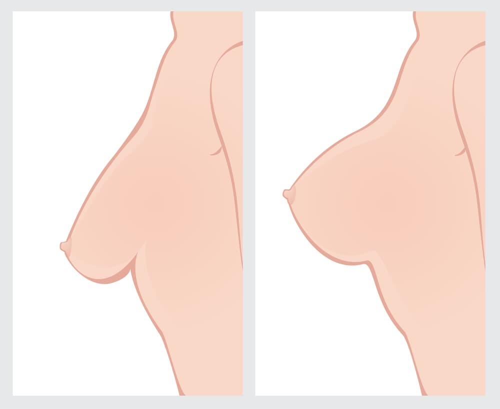 Breast-Lift-vs-Breast-Implant-Difference-houstonplasticsurgery.net