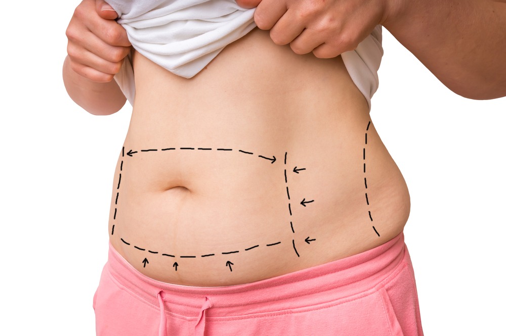 How Long Does It Take to Recover from a Tummy Tuck?