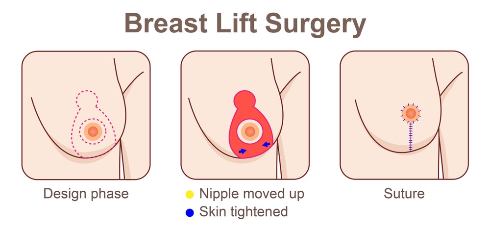 What Is the Recovery Time for a Breast Lift