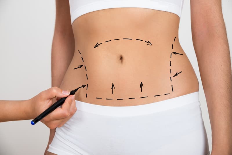 what-to-expect-after-liposuction-Michael-J-Streitmann-MD-Houston