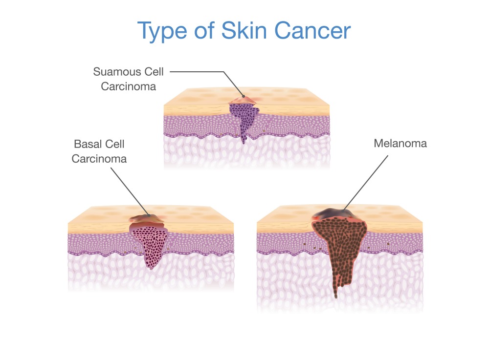 Skin Cancer Types Chart