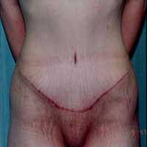 Abdominoplasty after 4