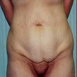 Abdominoplasty before 4