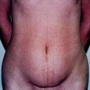 Abdominoplasty before 7