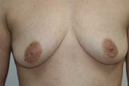 Breast Augmentation Before 2