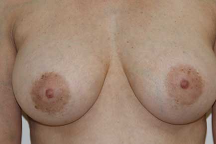 Breast Augmentation after 2