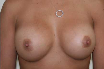 Breast Augmentation after 4