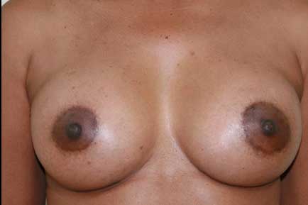 Breast Augmentation after 6