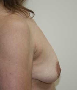 Breast Augmentation before 1
