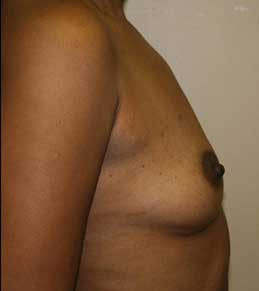 Breast Augmentation before 5