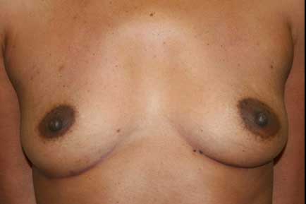Breast Augmentation before 6