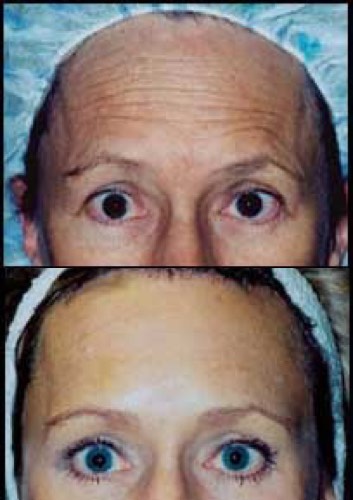 brow-before-after