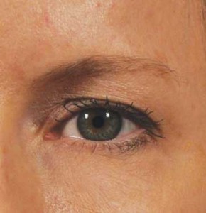 ultherapy_brow_before_1